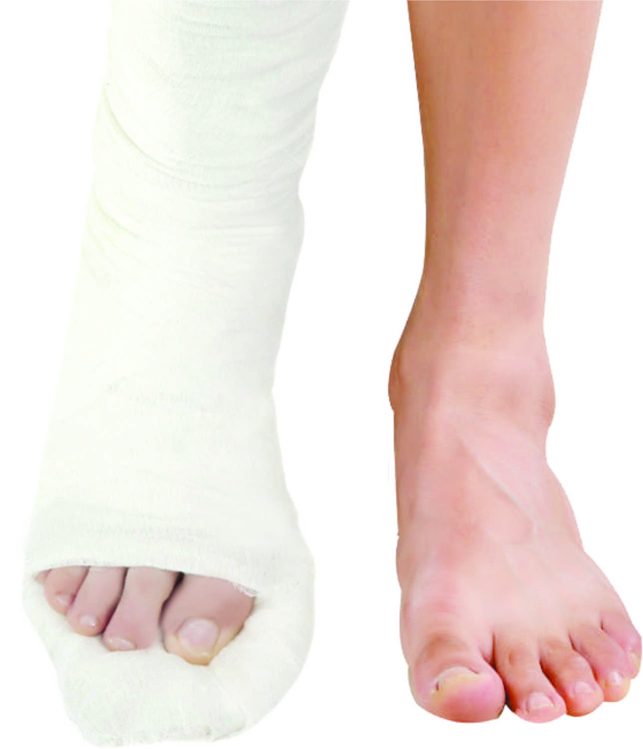 Top Cast Plaster of Paris Bandage BP 15 X 2.7M (Pack of 12) by Dynamic Techno Medicals-HEALTH &PERSONAL CARE-dealsplant